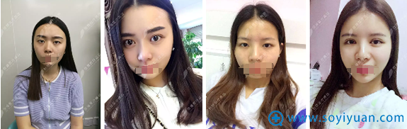 <!--<i data=20240710 data-id=13396></i>-->美容医院双眼皮案例 <!--<i data=20240710 data-id=13396></i>-->美容医院双眼皮案例
