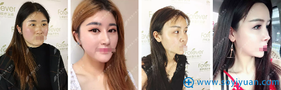 <!--<i data=20240710 data-id=13396></i>-->美容医院隆鼻案例 <!--<i data=20240710 data-id=13396></i>-->美容医院隆鼻案例