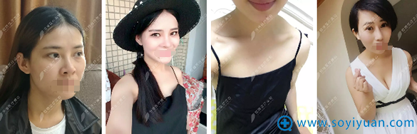 成都很恒博自体脂肪丰面部、丰胸案例 成都很恒博自体脂肪丰面部、丰胸案例