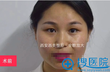 西安西美全眼放大术前照 西安西美全眼放大术前照