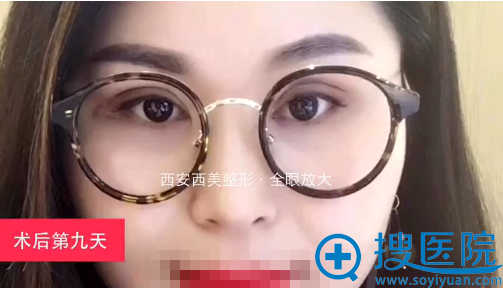 西安西美全眼放大术后恢复照片 西安西美全眼放大术后恢复照片