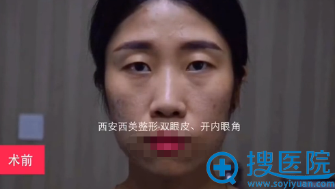 西安西美双眼皮+内开眼角术前照 西安西美双眼皮+内开眼角术前照