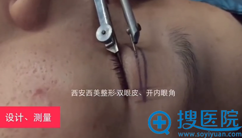 西安西美双眼皮+内开眼角术前设计 西安西美双眼皮+内开眼角术前设计