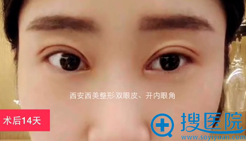 西安西美双眼皮+内开眼角术后恢复 西安西美双眼皮+内开眼角术后恢复