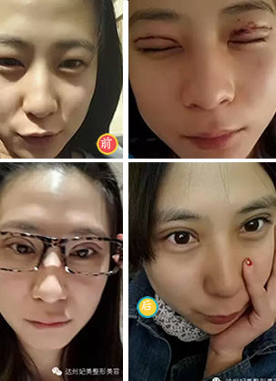 达州妃美整形双眼皮效果好吗 双眼皮真人秀给你看