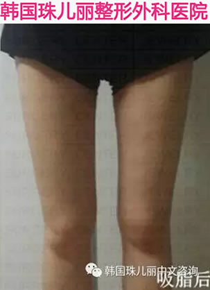吸脂瘦腿效果怎么样?在韩国珠儿丽做大腿吸脂后瘦了8厘米