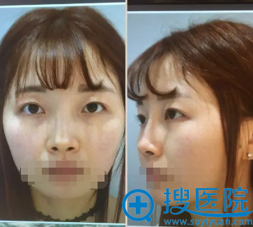 <!--<i data=20240710 data-id=12479></i>-->整容刘祎双眼皮+开眼角术前 <!--<i data=20240710 data-id=12479></i>-->整容刘祎双眼皮+开眼角术前
