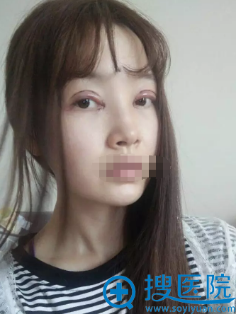 刘祎双眼皮+开眼角术后天照片 刘祎双眼皮+开眼角术后天照片