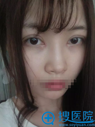 <!--<i data=20240710 data-id=12479></i>-->刘祎双眼皮+开眼角拆线后效果 <!--<i data=20240710 data-id=12479></i>-->刘祎双眼皮+开眼角拆线后效果