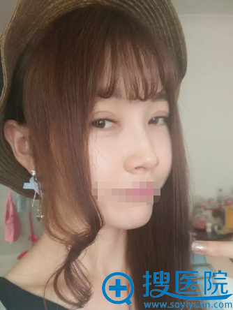 <!--<i data=20240710 data-id=12479></i>-->刘祎双眼皮+开眼角术后18天恢复效果 <!--<i data=20240710 data-id=12479></i>-->刘祎双眼皮+开眼角术后18天恢复效果