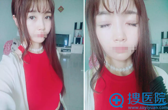 刘祎双眼皮+开眼角术后28天睁眼闭眼效果 刘祎双眼皮+开眼角术后28天睁眼闭眼效果