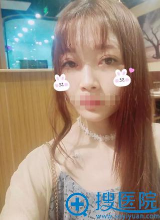 <!--<i data=20240710 data-id=12479></i>-->刘祎双眼皮+开眼角术后35天恢复效果 <!--<i data=20240710 data-id=12479></i>-->刘祎双眼皮+开眼角术后35天恢复效果