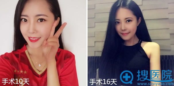 注射半个月恢复效果 注射半个月恢复效果