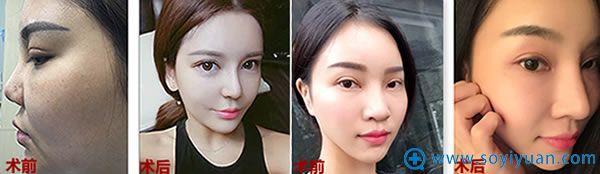 广州艺美李闯鼻修复前后对比案例 广州艺美李闯鼻修复前后对比案例
