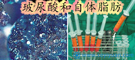 填充泪沟玻尿酸和自体脂肪应该怎么选?有什么区别? 填充泪沟玻尿酸和自体脂肪应该怎么选?有什么区别?