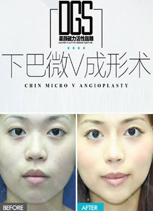 北京南加整形医院做假体下巴怎么样 DGS星颜下巴微V成形术