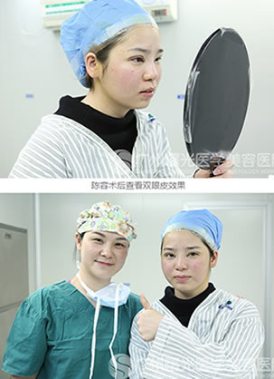 透露!广州曙光整形医院王娟割双眼皮怎么样?需要多少钱?