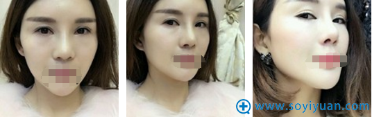 南京<!--<i data=20240710 data-id=17305></i>-->朴光哲鼻修复拆线后效果 南京<!--<i data=20240710 data-id=17305></i>-->朴光哲鼻修复拆线后效果