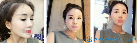 南京<!--<i data=20240710 data-id=17305></i>-->朴光哲鼻修复术后恢复照 南京<!--<i data=20240710 data-id=17305></i>-->朴光哲鼻修复术后恢复照