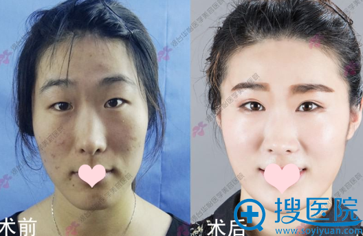 烟台华怡张平院长双眼皮案例 烟台华怡张平院长双眼皮案例