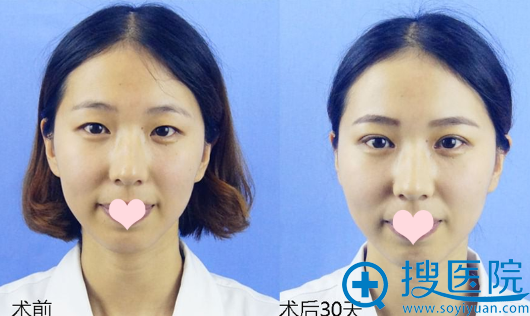 烟台华怡张平医生双眼皮案例 烟台华怡张平医生双眼皮案例