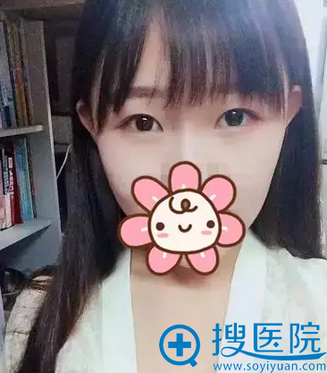 <!--<i data=20240710 data-id=12546></i>-->割双眼皮术前照 <!--<i data=20240710 data-id=12546></i>-->割双眼皮术前照