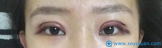内双妹子恩喜割双眼皮天 内双妹子恩喜割双眼皮天