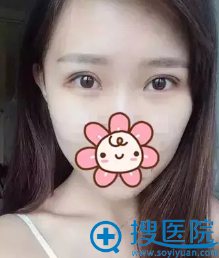 <!--<i data=20240710 data-id=12546></i>-->割双眼皮拆线后效果 <!--<i data=20240710 data-id=12546></i>-->割双眼皮拆线后效果