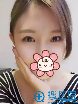 双眼皮术后5个月恢复照片 双眼皮术后5个月恢复照片