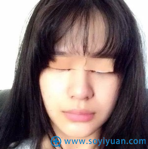 在上海伊莱美割双眼皮术后天 在上海伊莱美割双眼皮术后天