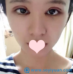 邱文苑主任双眼皮第二天 邱文苑主任双眼皮第二天