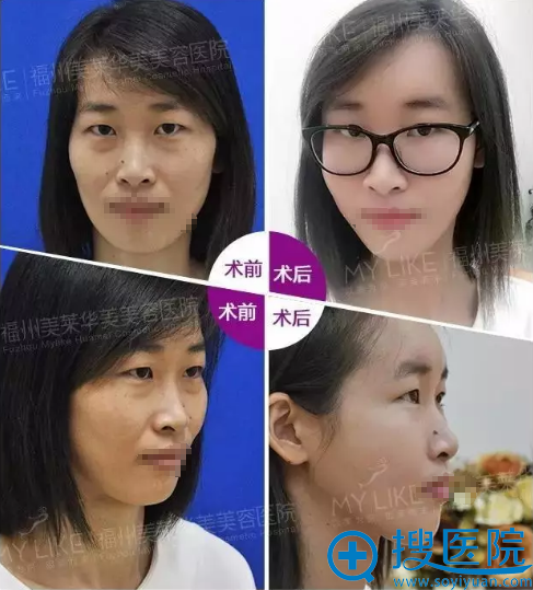 <!--<i data=20240710 data-id=14690></i>-->华美周珃纳米活细胞填充案例对比照片 <!--<i data=20240710 data-id=14690></i>-->华美周珃纳米活细胞填充案例对比照片