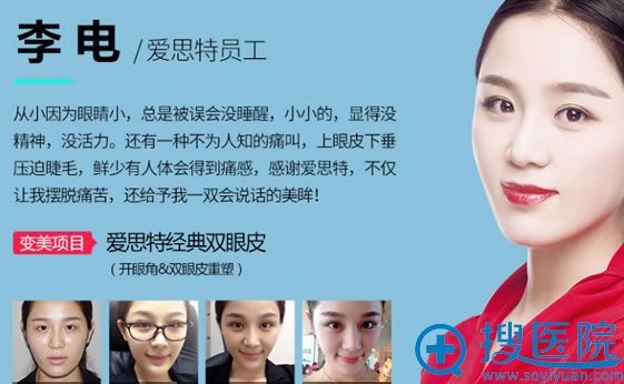 广西爱思特员工做双眼皮效果 广西爱思特员工做双眼皮效果