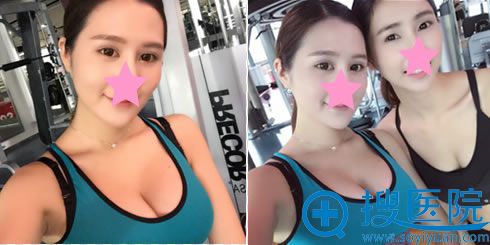 中家医家庭整形医院假体丰胸术后30天效果 中家医家庭整形医院假体丰胸术后30天效果
