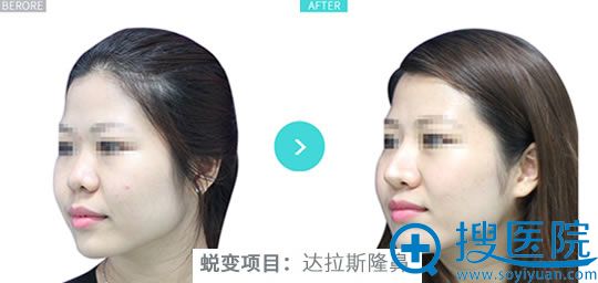 爱思特达拉斯隆鼻前后对比照片 爱思特达拉斯隆鼻前后对比照片