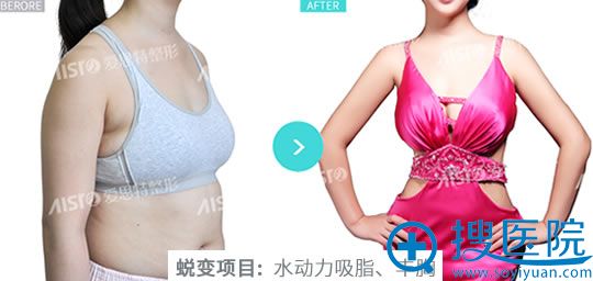 爱思特自体脂肪隆胸案例图 爱思特自体脂肪隆胸案例图