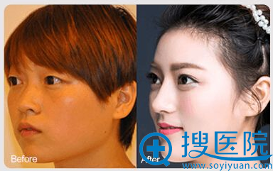 <!--<i data=20240710 data-id=12414></i>-->董茂林双眼皮+隆鼻案例 <!--<i data=20240710 data-id=12414></i>-->董茂林双眼皮+隆鼻案例