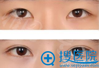 <!--<i data=20240710 data-id=12414></i>-->曾少林医生双眼皮案例 <!--<i data=20240710 data-id=12414></i>-->曾少林医生双眼皮案例