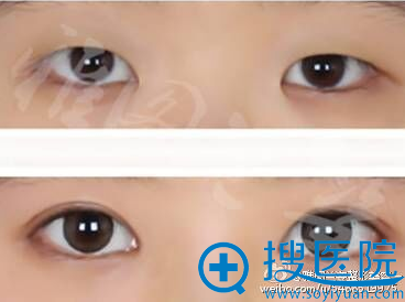 <!--<i data=20240710 data-id=12414></i>-->曾少林双眼皮对比图 <!--<i data=20240710 data-id=12414></i>-->曾少林双眼皮对比图