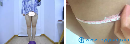 福州名韩陈声瑾水动力吸脂瘦大腿案例 拯救梨形身材