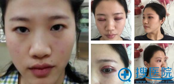 南充华美双眼皮案例效果图 南充华美双眼皮案例效果图
