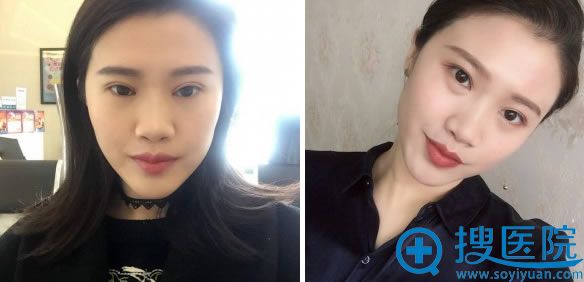 南充华美全切双眼皮6个月效果 南充华美全切双眼皮6个月效果