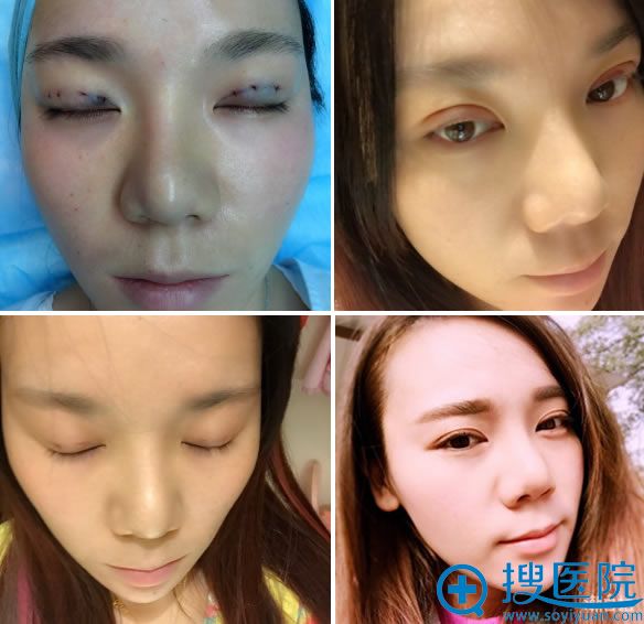 南充华美韩式三点双眼皮案例效果 南充华美韩式三点双眼皮案例效果