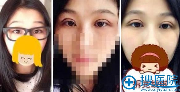 南充华美名媛全切双眼皮第10天效果 南充华美名媛全切双眼皮第10天效果