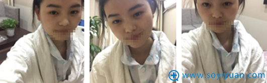 【真实分享】重庆星宸彭绍宗硅胶假体隆鼻+耳软骨鼻尖恢复日记