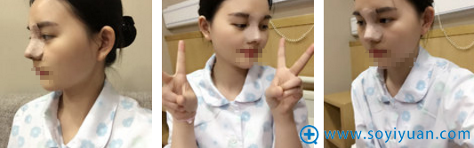 <!--<i data=20240710 data-id=11048></i>--><!--<i data=20240710 data-id=16803></i>-->硅胶隆鼻+耳软骨鼻尖术后3天图片 <!--<i data=20240710 data-id=11048></i>--><!--<i data=20240710 data-id=16803></i>-->硅胶隆鼻+耳软骨鼻尖术后3天图片