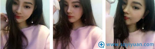 <!--<i data=20240710 data-id=16803></i>-->硅胶隆鼻+耳软骨鼻尖术后1个月恢复照片 <!--<i data=20240710 data-id=16803></i>-->硅胶隆鼻+耳软骨鼻尖术后1个月恢复照片