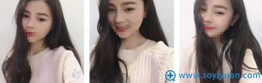 <!--<i data=20240710 data-id=11048></i>--><!--<i data=20240710 data-id=16803></i>-->硅胶隆鼻术后2个月恢复效果 <!--<i data=20240710 data-id=11048></i>--><!--<i data=20240710 data-id=16803></i>-->硅胶隆鼻术后2个月恢复效果