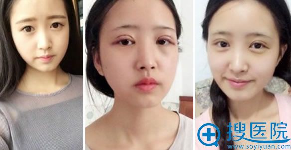 南充华美名媛双眼皮效果怎么样 南充华美名媛双眼皮效果怎么样