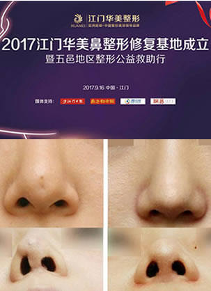 【免费鼻整形修复】江门华美招募隆鼻失败者 助你实现翘挺美鼻